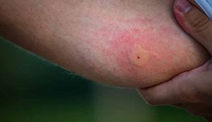 O înțepătură de tânțar le-a fost fatală. Două decese provocate de virusul West Nile 6 - Starea de sanatate 17695 mosquito bite 1269483899 - Starea de sanatate