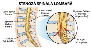 Durerea de spate și stenoza spinală: Tratamentul cu pastile care ar putea înlocui operația 6 - Starea de sanatate spinal - Starea de sanatate